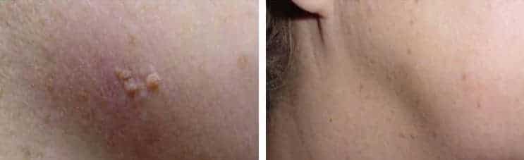CryoProbe_skintag_before-after