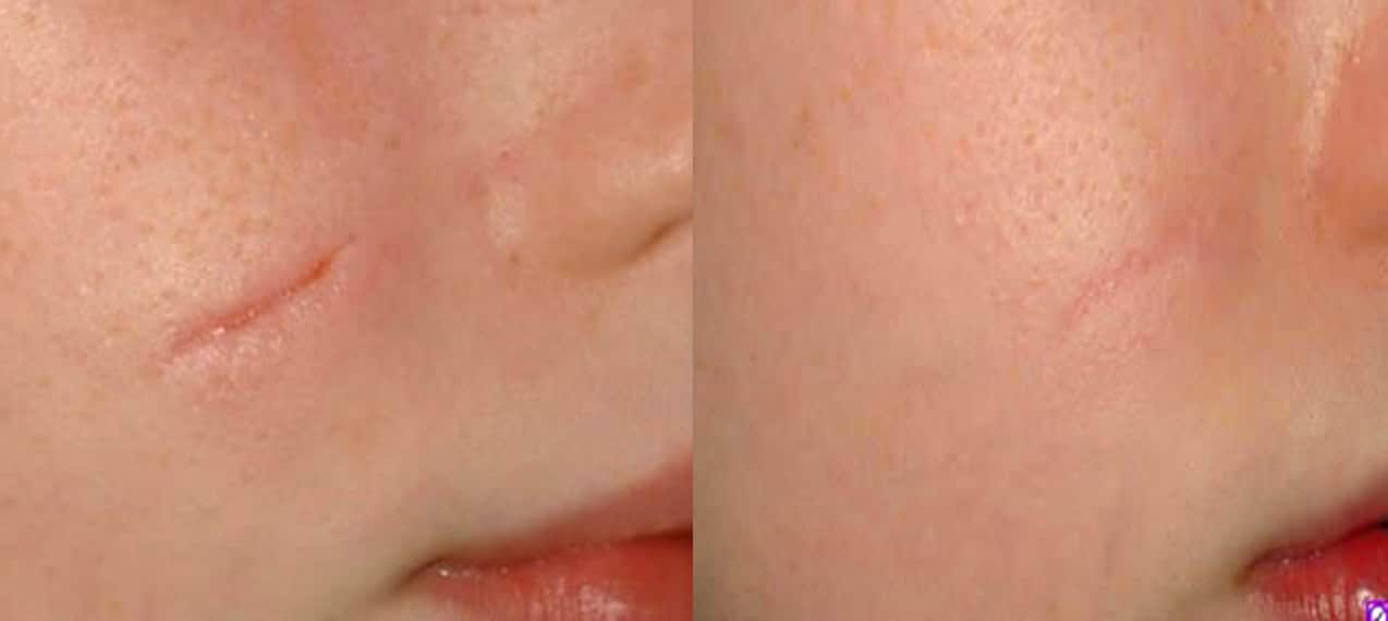 Scar-Removal-Before-and-After-Images-2.jpg-nggid03110-ngg0dyn-1280x922x100-00f0w010c010r110f110r010t010