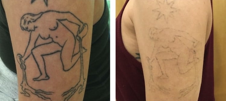 Laser Tattoo Removal - Verve Med Sap - Upland, CA
